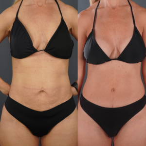 Two side-by-side images show a woman in a black bikini before and after a visible change in abdominal tone and skin texture.