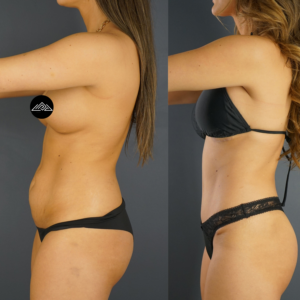 Side-by-side comparison of a woman before and after a body transformation, showing changes in the abdomen, waist, and chest areas.