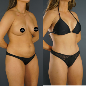 Side-by-side before and after photos of a woman in black underwear, showing body changes, likely from cosmetic surgery or weight loss.