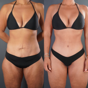 Side-by-side comparison of a woman in a black bikini before and after a body transformation, showing changes in abdomen and waist.