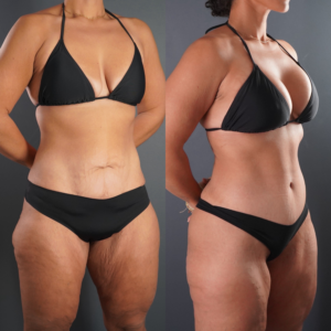 Side-by-side comparison of a woman in a black bikini before and after body contouring, showing reduced loose skin and a slimmer appearance in the after photo.
